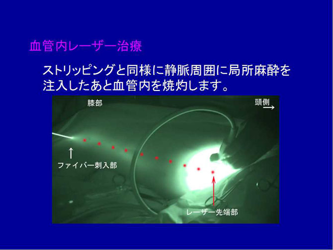 下肢静脈瘤血管内焼灼術