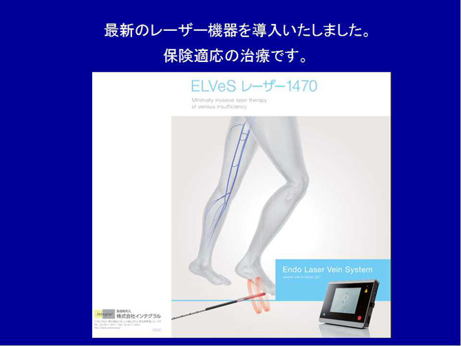 下肢静脈瘤血管内焼灼術