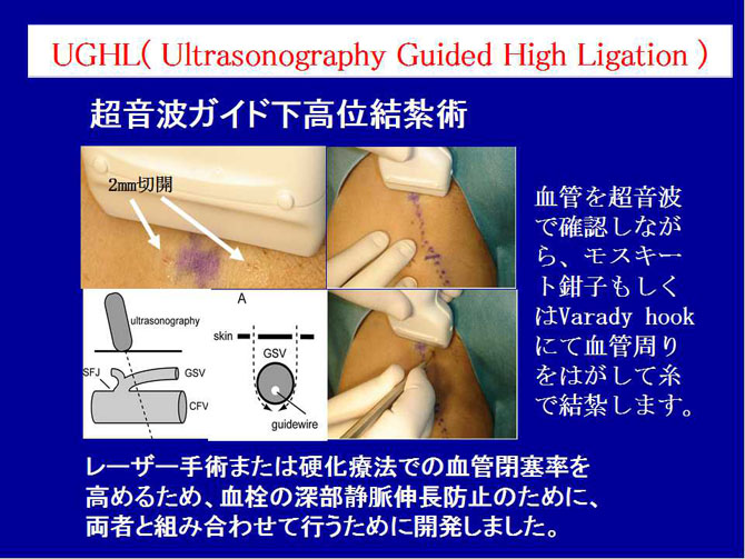 下肢静脈瘤血管内焼灼術